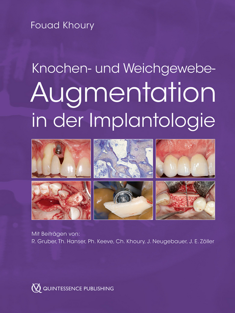 Knochen- und Weichgewebeaugmentation in der Implantologie - 