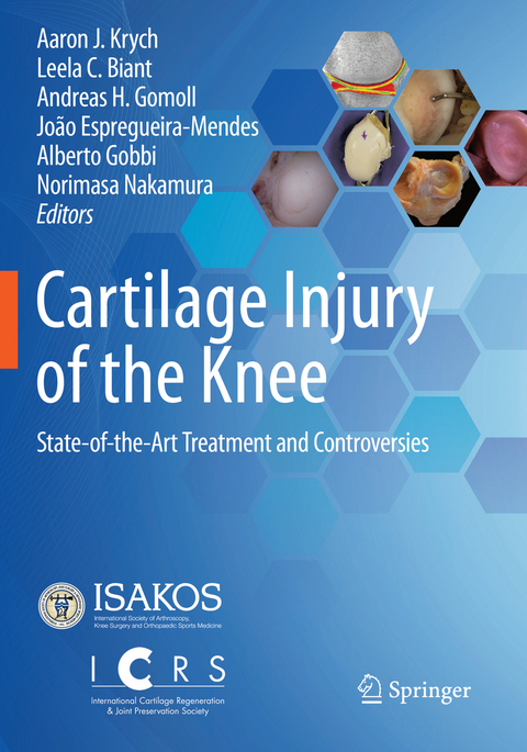 Cartilage Injury of the Knee - 