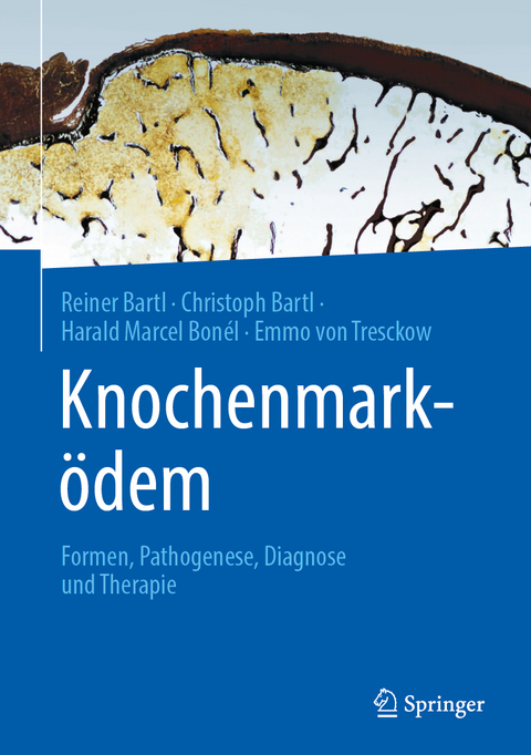 Knochenmarködem - Reiner Bartl, Christoph Bartl, Harald Marcel Bonél, Emmo Von Tresckow
