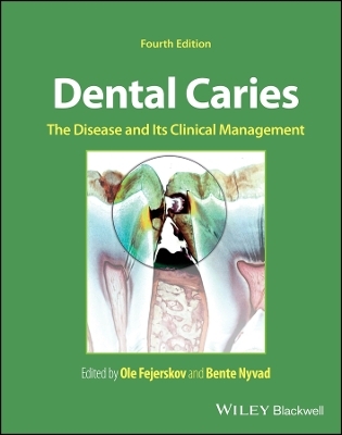 Dental Caries - 