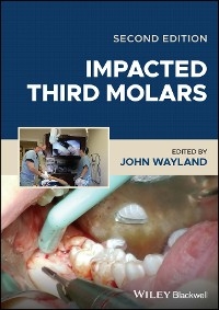 Impacted Third Molars - 