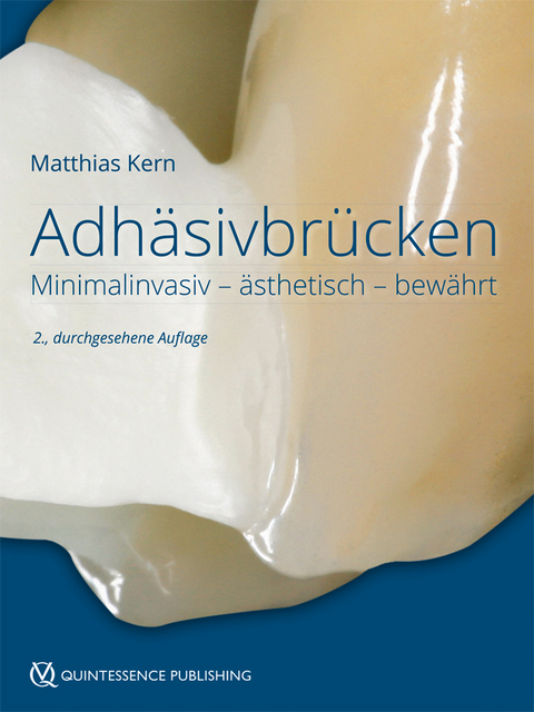 Adhäsivbrücken - Matthias Kern