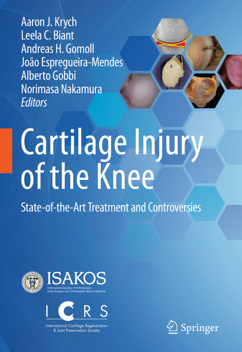 Cartilage Injury of the Knee - 
