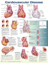 Cardiovascular Disease Anatomical Chart - 