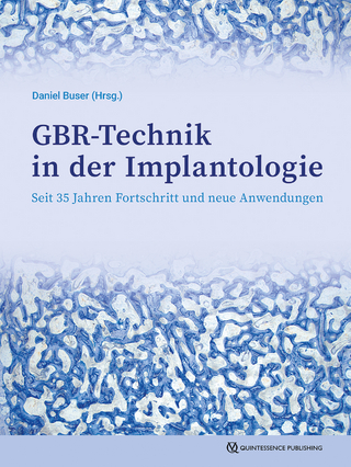 GBR-Technik in der Implantologie