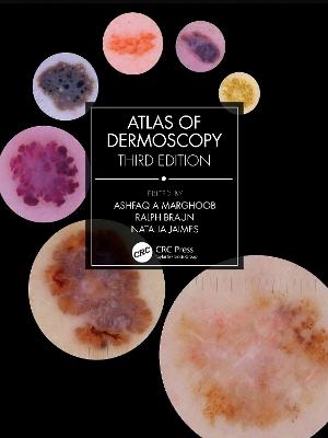 Atlas of Dermoscopy - Ashfaq A Marghoob, Ralph Braun, Natalia Jaimes