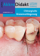 Chirurgische Kronenverl&auml;ngerung - Spiros Paraskevas