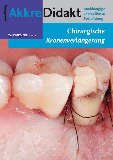 Chirurgische Kronenverl&auml;ngerung - Spiros Paraskevas