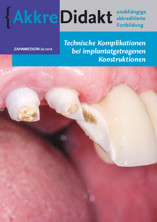 Technische Komplikationen bei implantatgetragenen Konstruktionen