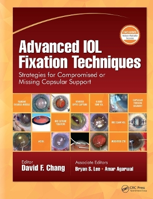 Advanced IOL Fixation Techniques