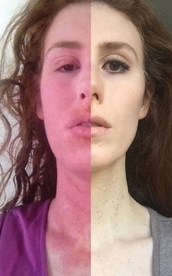 Curing My Incurable Eczema