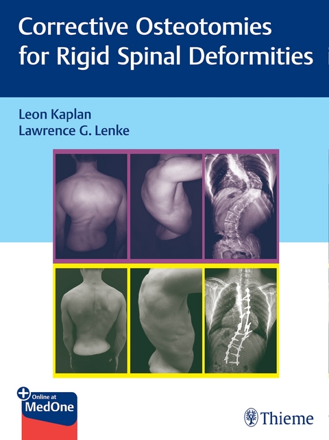Corrective Osteotomies for Rigid Spinal Deformities - 