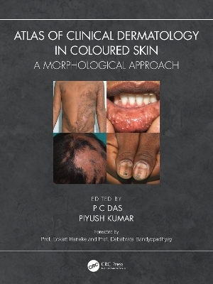 Atlas of Clinical Dermatology in Coloured Skin