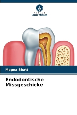 Endodontische Missgeschicke - Megna Bhatt