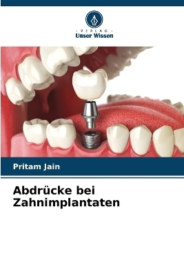 Abdrücke bei Zahnimplantaten