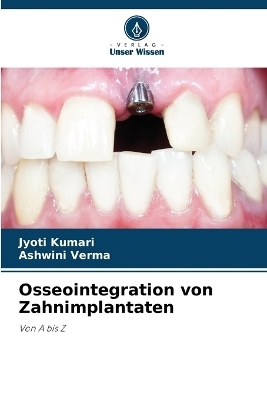 Osseointegration von Zahnimplantaten - Jyoti Kumari, Ashwini Verma