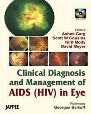 Clinical Diagnosis Management of Aids [HIV] in Eye