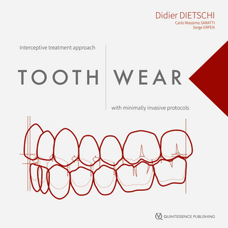 Tooth Wear