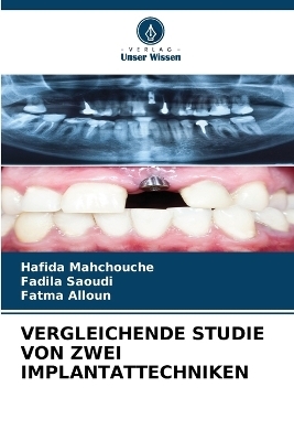 Vergleichende Studie Von Zwei Implantattechniken - Hafida Mahchouche, Fadila Saoudi, Fatma Alloun