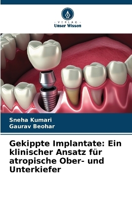 Gekippte Implantate - Sneha Kumari, Gaurav Beohar