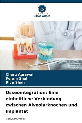 Osseointegration - Charu Agrawal, Foram Shah, Riya Shah