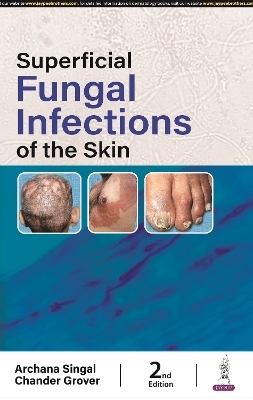 Superficial Fungal Infections of the Skin