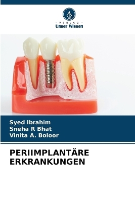Periimplant&auml;re Erkrankungen - Syed Ibrahim, Sneha R Bhat, Vinita A Boloor