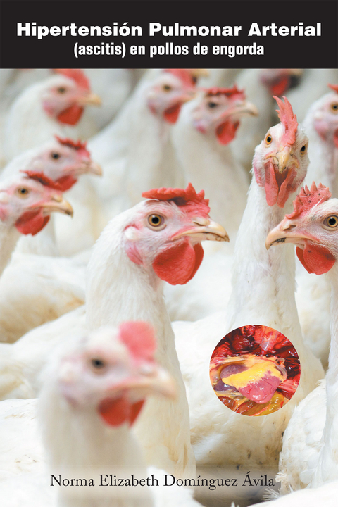 Hipertensión Pulmonar Arterial - Norma Elizabeth Domínguez Avila