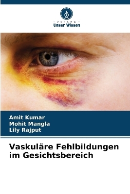 Vaskul&auml;re Fehlbildungen im Gesichtsbereich - Amit Kumar, Mohit Mangla, Lily Rajput