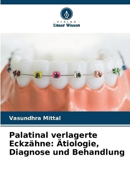 Palatinal verlagerte Eckzähne