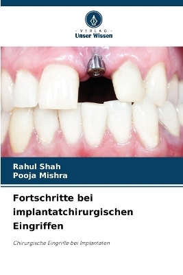 Fortschritte bei implantatchirurgischen Eingriffen - RAHUL SHAH, Pooja Mishra