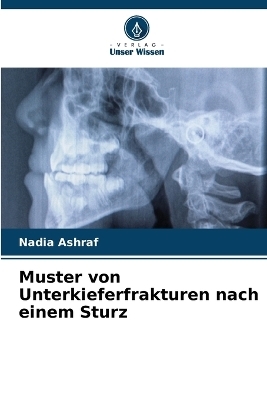 Muster von Unterkieferfrakturen nach einem Sturz