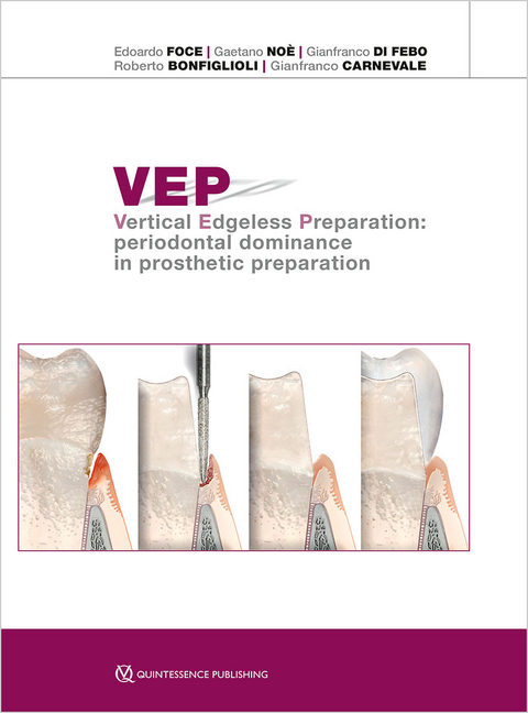 VEP Vertical Edgeless Preparation - Edoardo Foce, Gaetano No&egrave;, Gianfranco Di Febo, Roberto Bonfiglioli, Gianfranco Carnevale