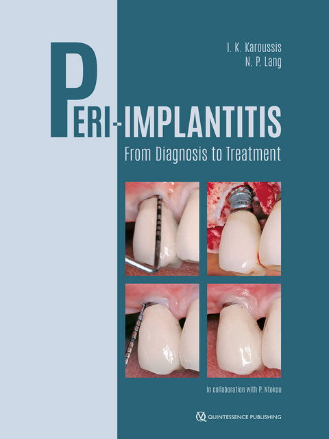 Peri-Implantitis - Ioannis K. Karoussis, Niklaus P. Lang