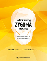 Understanding Zygoma Implants