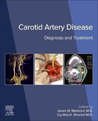Carotid Artery Disease - 