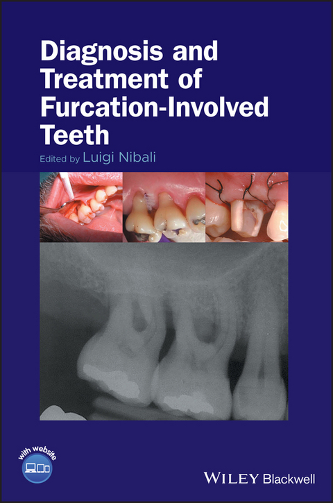 Diagnosis and Treatment of Furcation-Involved Teeth - 