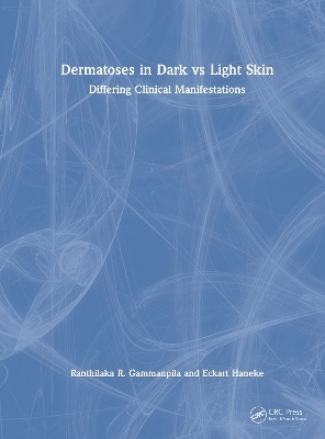 Dermatoses in Dark Vs Light Skin - Ranthilaka R. Gammanpila, Eckart Haneke