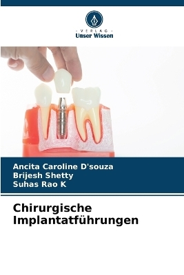 Chirurgische Implantatf&uuml;hrungen - Ancita Caroline D'souza, Brijesh Shetty, Suhas Rao K