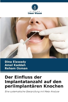 Der Einfluss der Implantatanzahl auf den periimplantären Knochen
