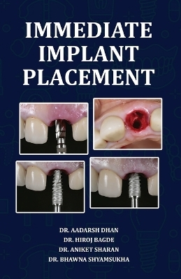 Immediate Implant Placement