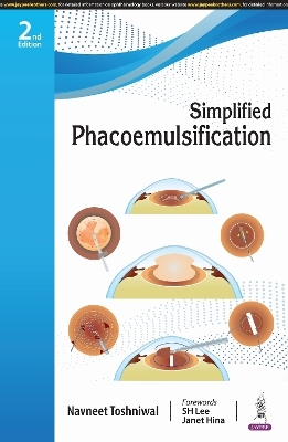 Simplified Phacoemulsification - Navneet Toshniwal