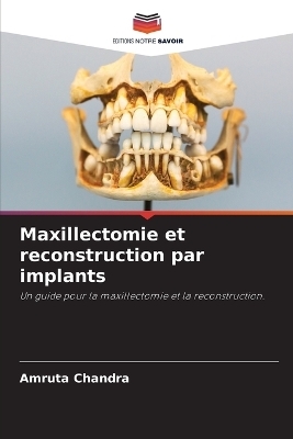 Maxillectomie et reconstruction par implants - Amruta Chandra