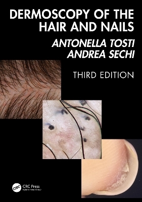 Dermoscopy of the Hair and Nails 3e - Antonella Tosti, Andrea Sechi