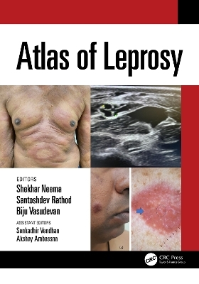 Atlas of Leprosy - 