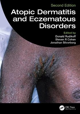 Atopic Dermatitis and Eczematous Disorders