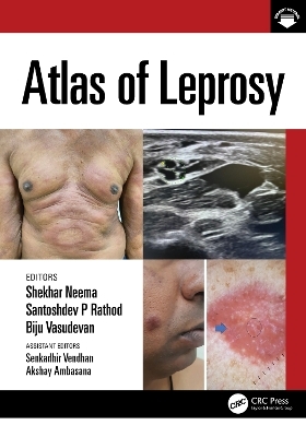 Atlas of Leprosy - 