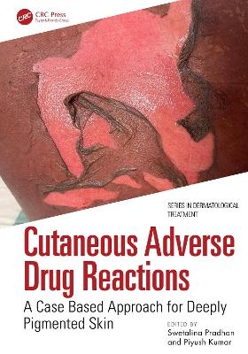 Cutaneous Adverse Drug Reactions - 