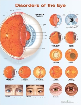Disorders of the Eye Anatomical Chart - Anatomical Chart Company