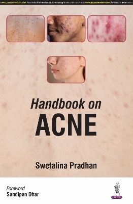 Handbook on Acne - Swetalina Pradhan, Rashid Shahid, Debopriya Paul